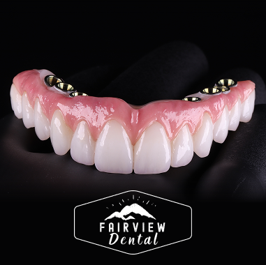 Hybrid Implant Bridge