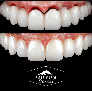 Porcelain Implant Bridge